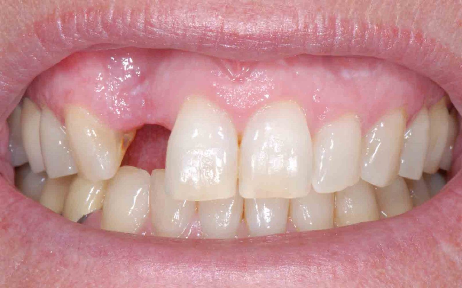 Kaybedilen dişlerin ağız sağlığına etkisi nedir?