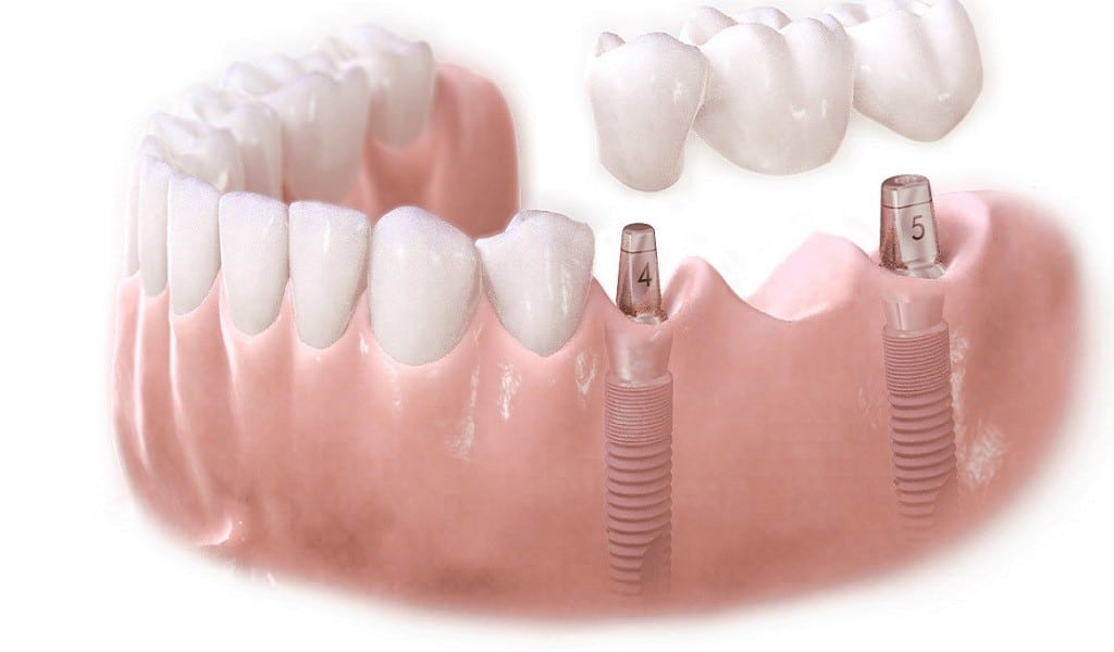 Kaybedilen dişlerin tedavisinde çeneye vida ile dişin entegre edilmesine implant denir.