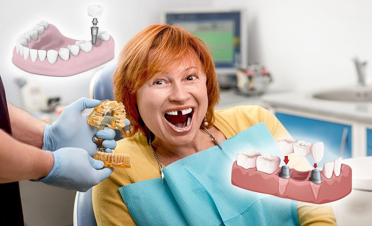 Kaybedilen dişlerin en iyi tedavi şekli implanttır.